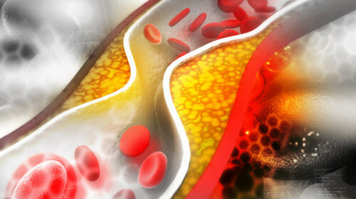 1669873188 cholesterol plaque artery